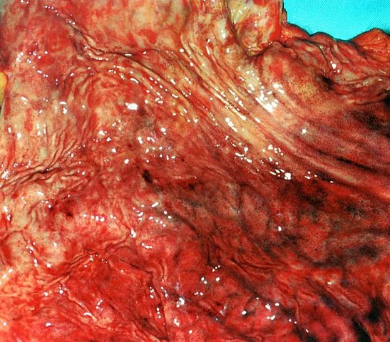 Erosive Gastritis